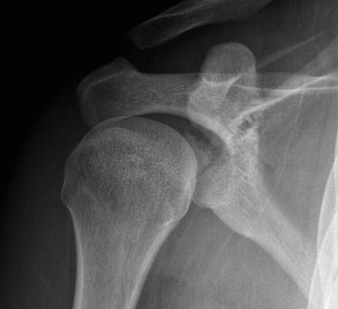 Glenoid Fracture